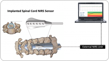 UBC Orthopaedics Researchers Receive Clinical Trial Funding from the United States Department of Defense Spinal Cord Injury Research Program