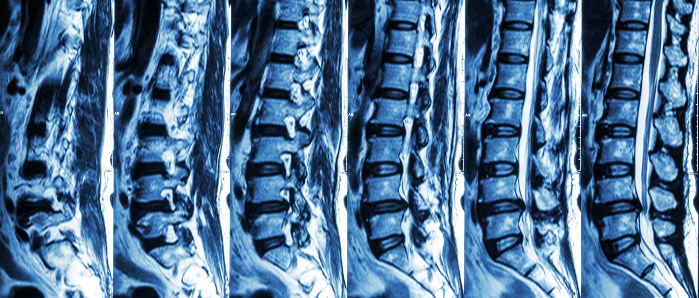 International Spinal Cord Injury Biobank launches a new website